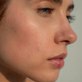 Atmosphera CLARIFY PATCH™ - Blemish Patches Lifestyle